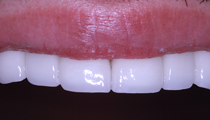 Implant and Veneer After