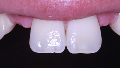 Implant and Veneer Before