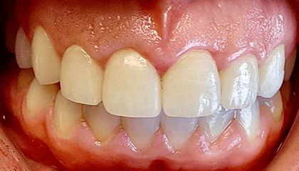 Veneers After