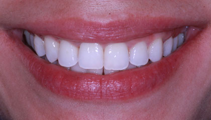 Invisalign After
