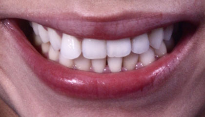 Invisalign Before