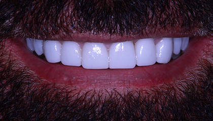 Veneers After