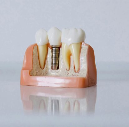 What to Expect During the Dental Implant Process