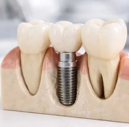 When Are Dental Bridges Recommended Over Dental Implants?